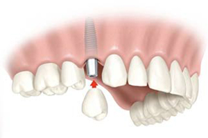 имплантация зубов.jpg